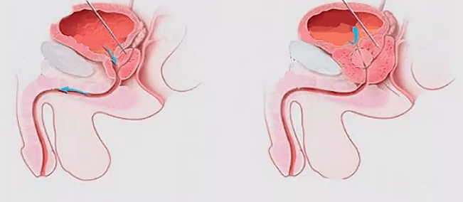 Anzeichen einer Prostatitis bei Männern
