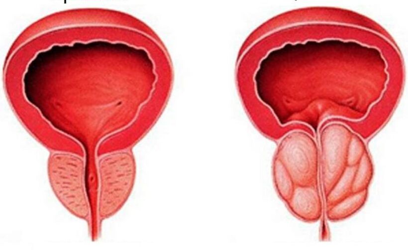 Prostata