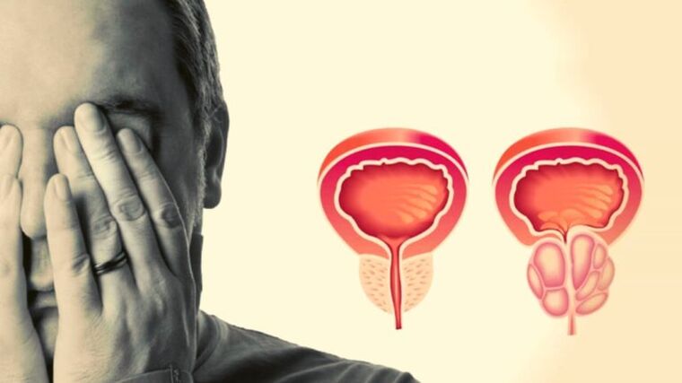 Ein Mann hat Prostatitis