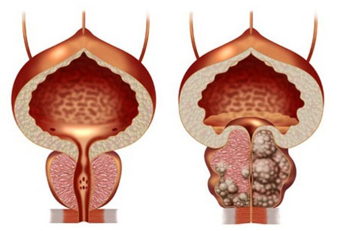 gesunde Prostata und Prostataadenom